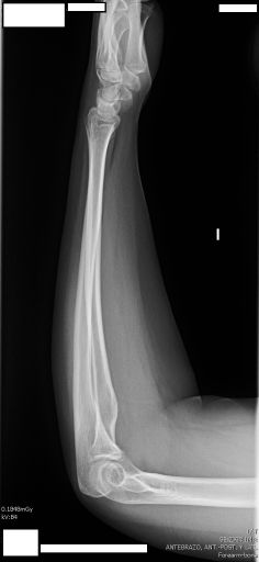Lateral Forearm Diagram